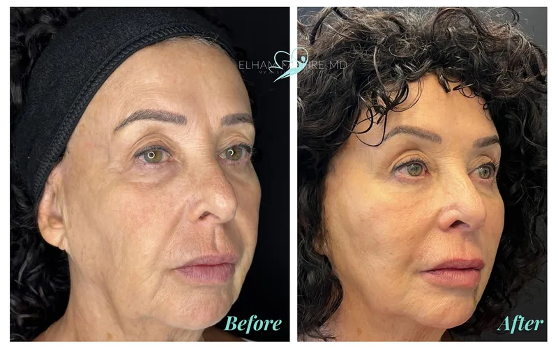 PDO Threads before and after by Dr. Elham Fakhre