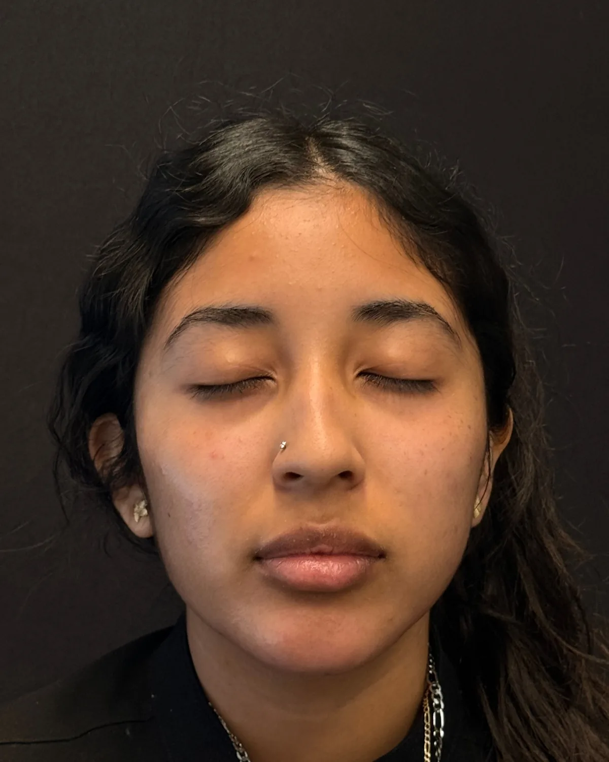 Front view after Radiesse facial balancing