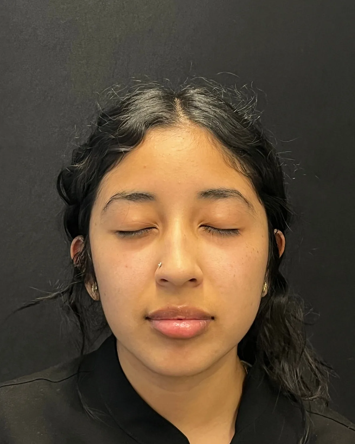 Front view before Radiesse facial balancing