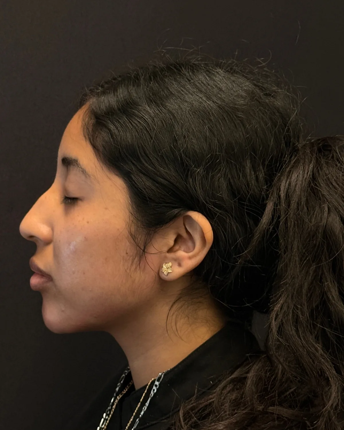 Left profile after jawline and chin filler
