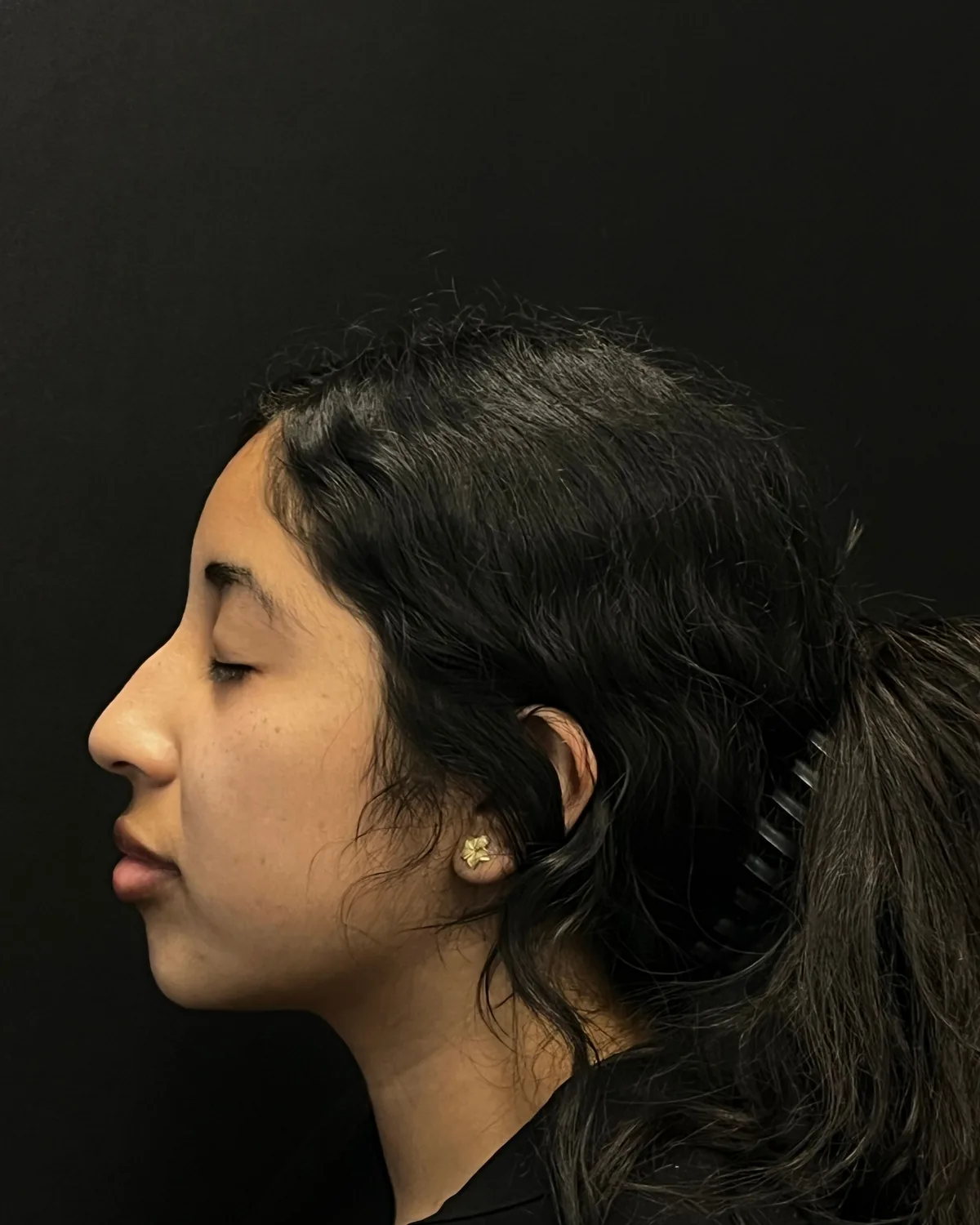 Left profile before jawline and chin filler