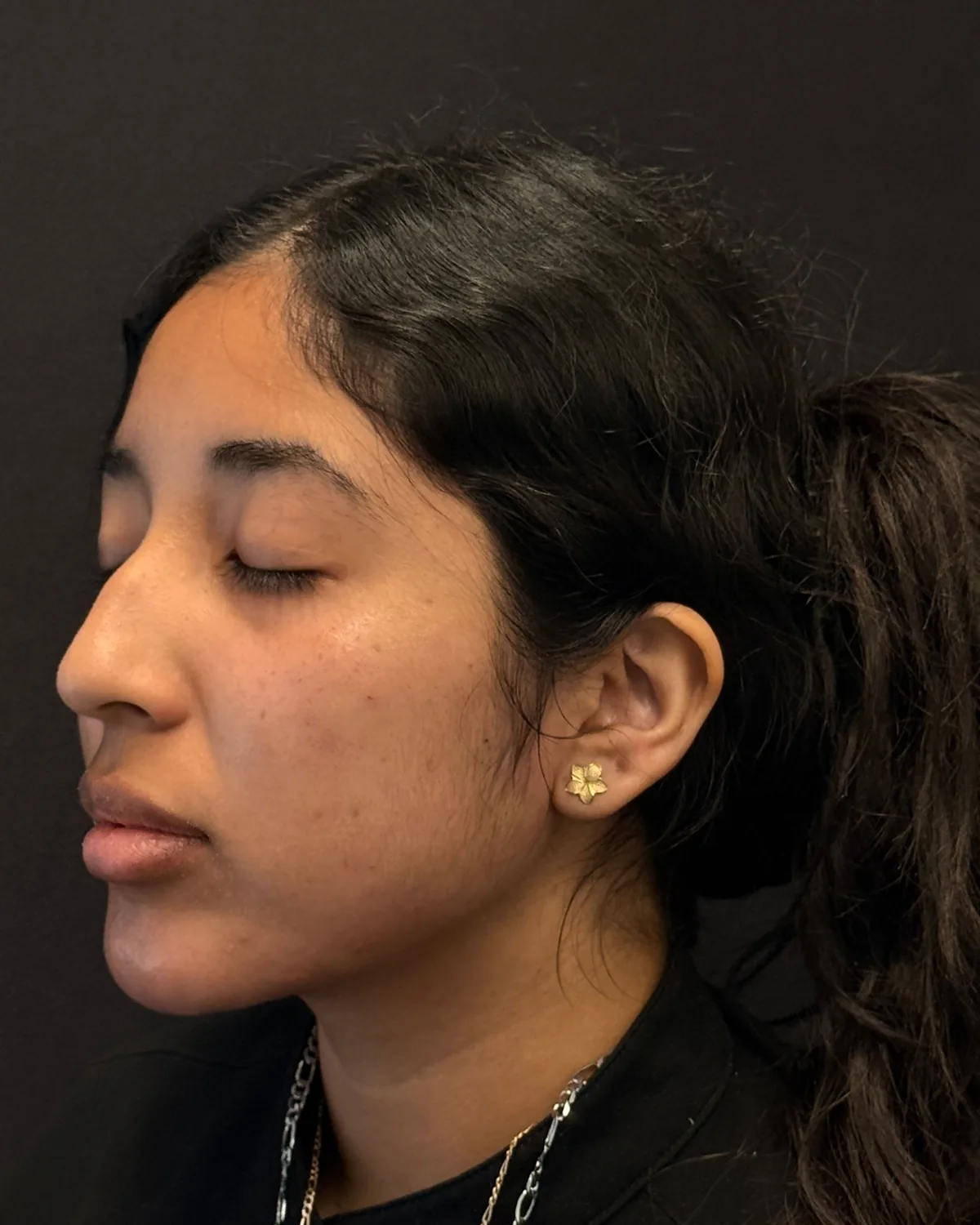 Left angle after cheek and jawline filler