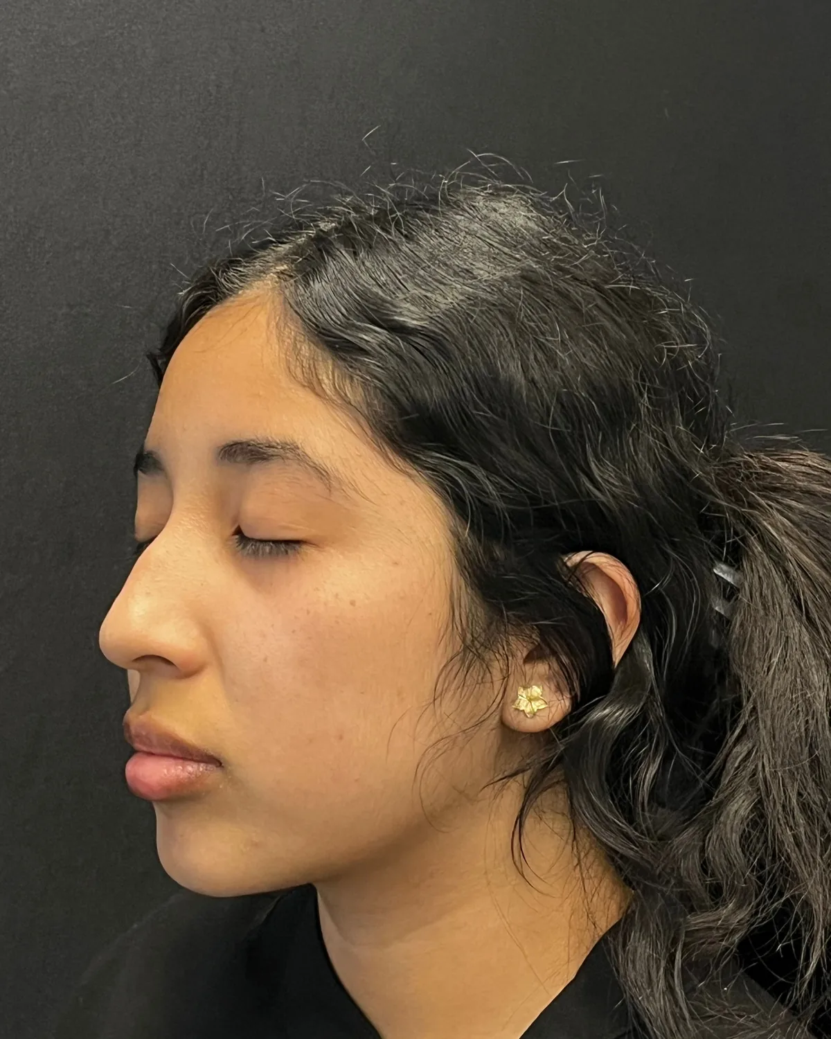 Left angle before cheek and jawline filler