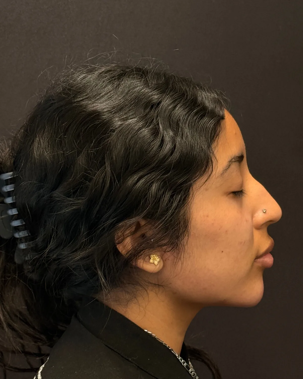 Right profile after lip and chin filler
