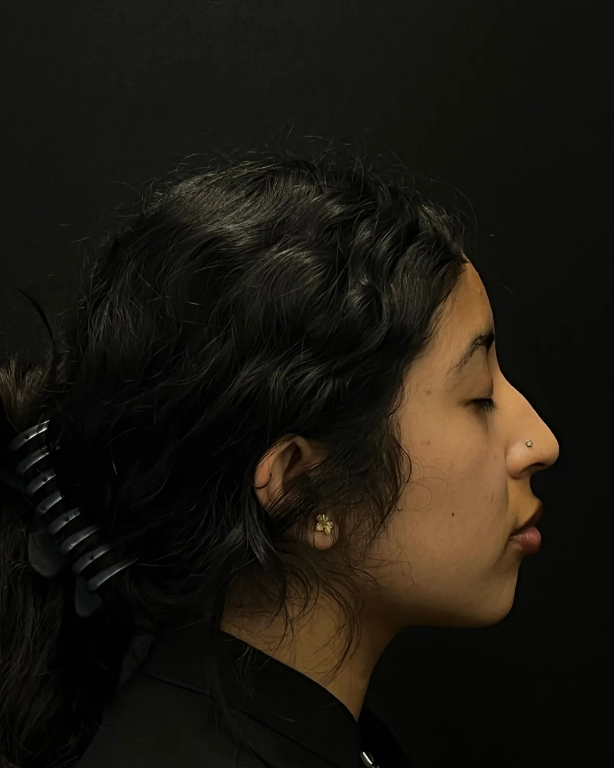 Right profile before lip and chin filler