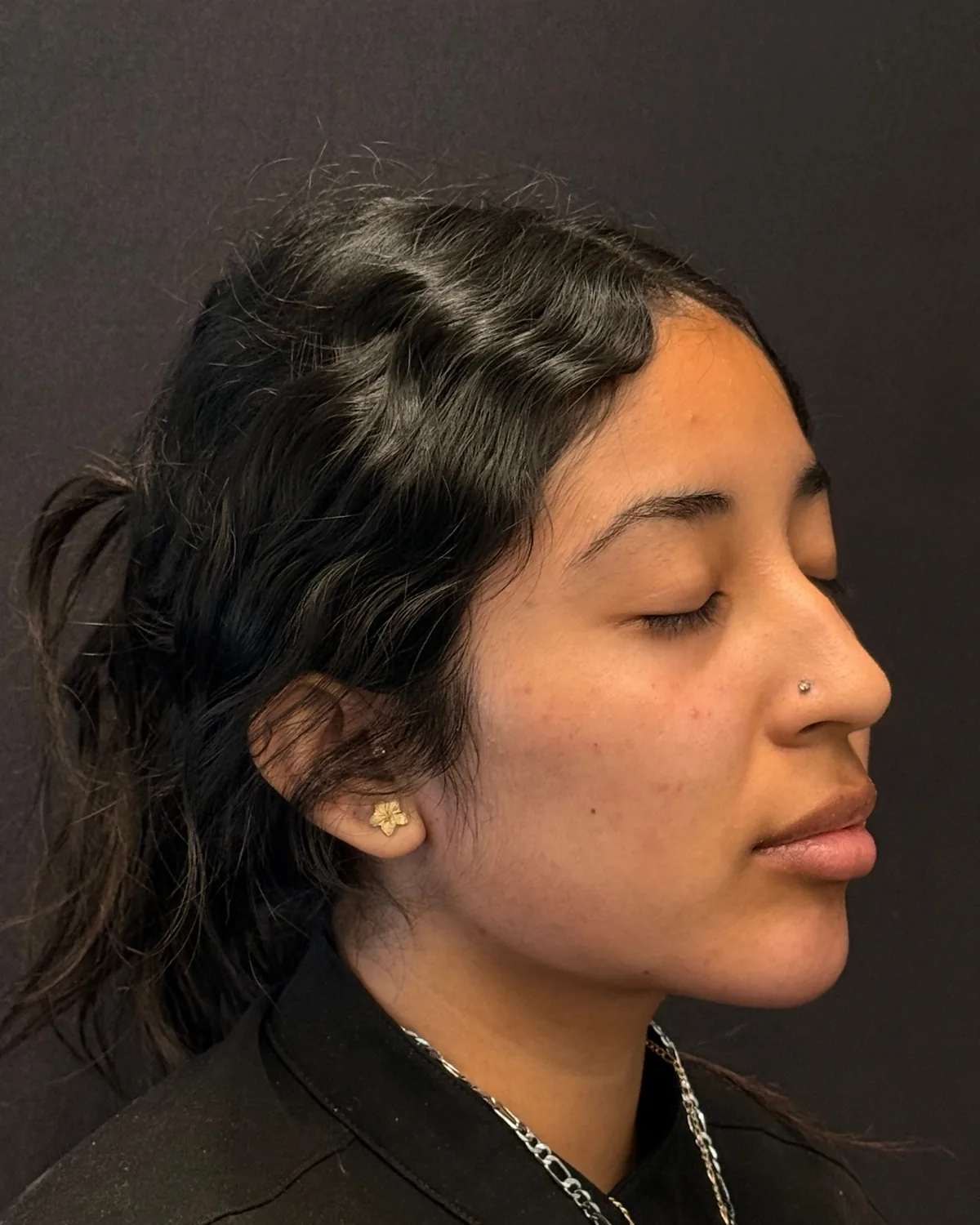 Right angle after cheek and jawline filler