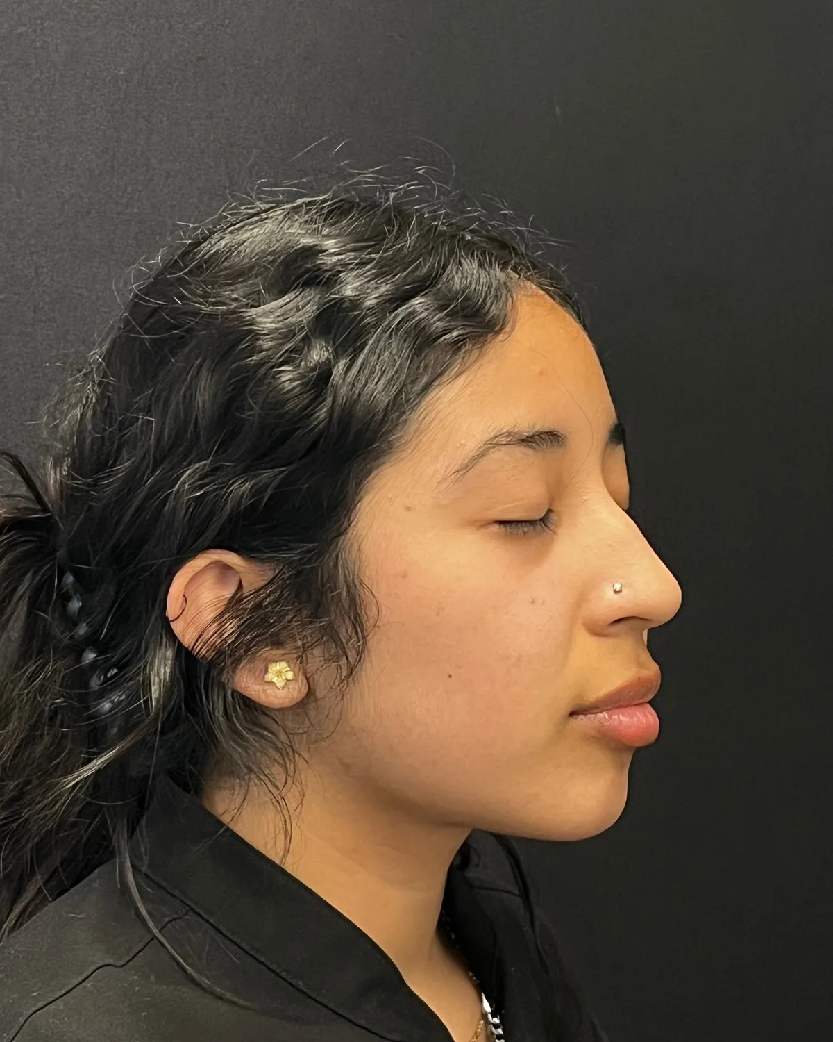 Right angle before cheek and jawline filler