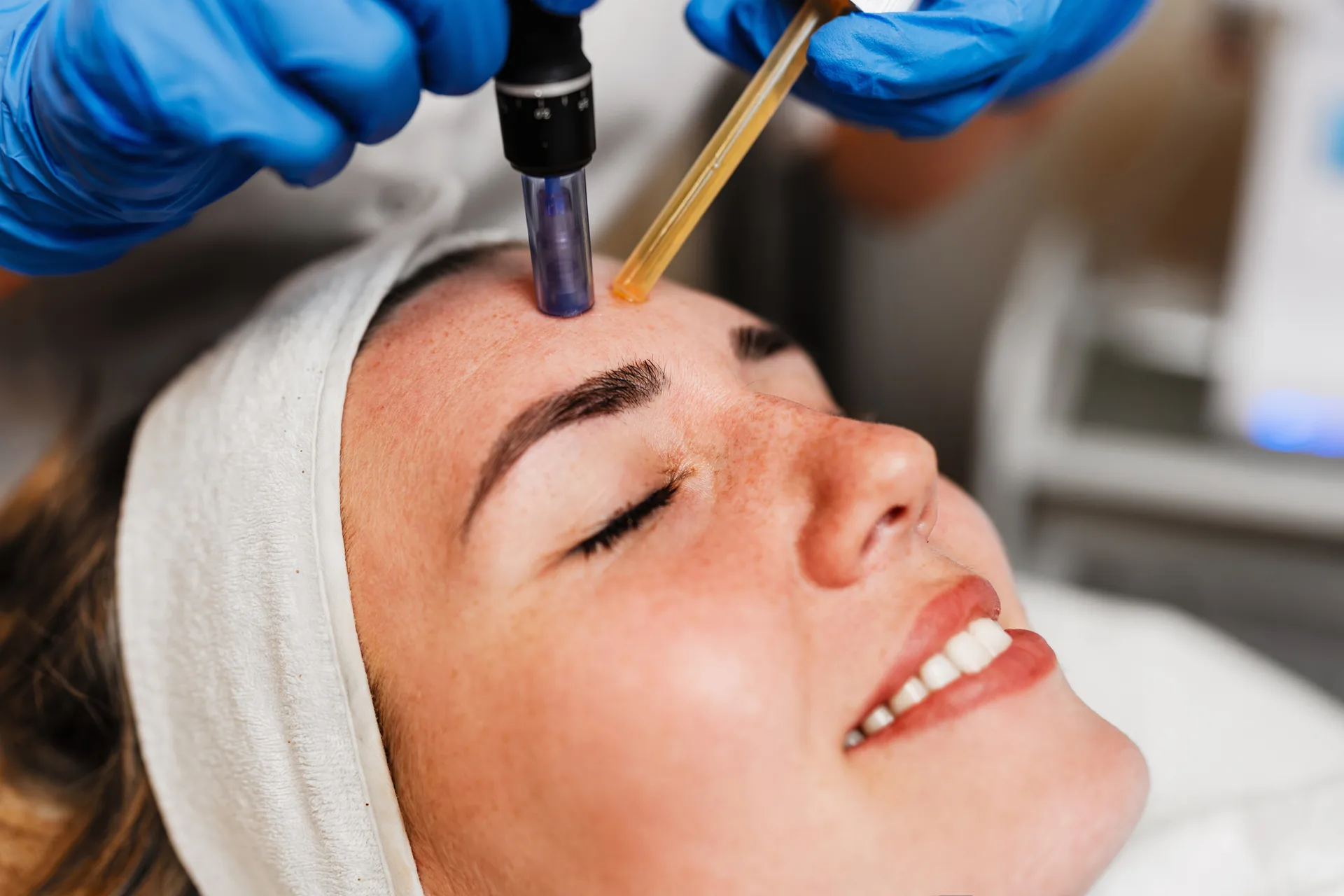 Microneedling with PRP in Los Angeles